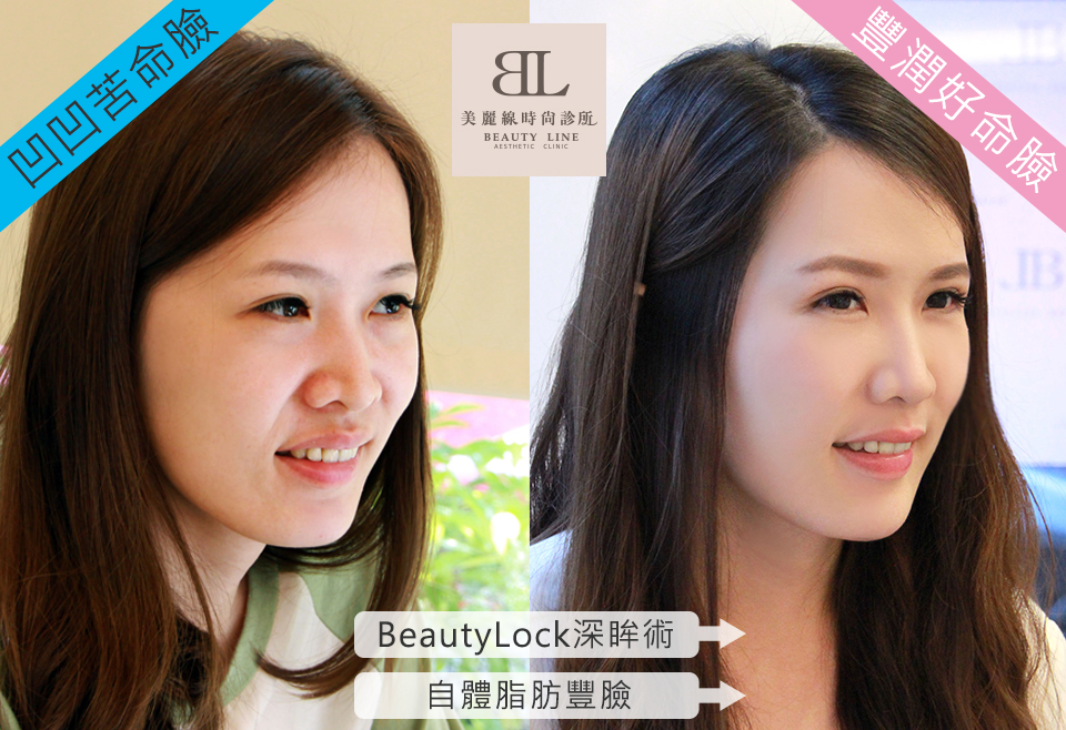 自體脂肪豐臉 X 深眸術