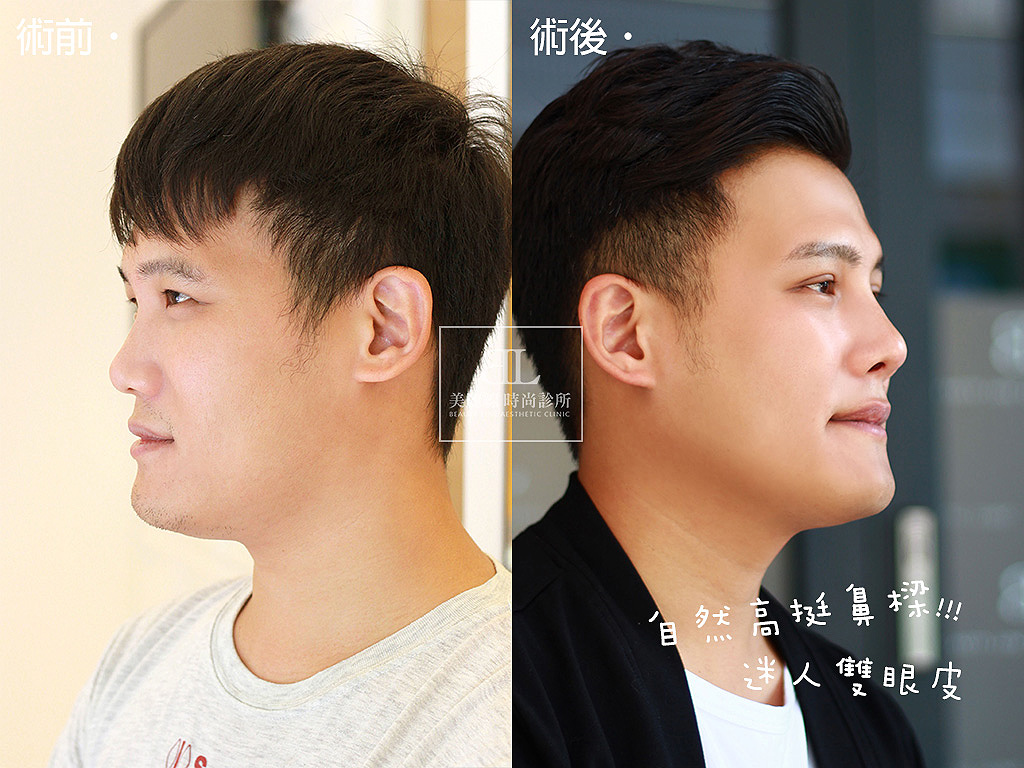 韓式無痕隆鼻 x BeautyLock深眸術