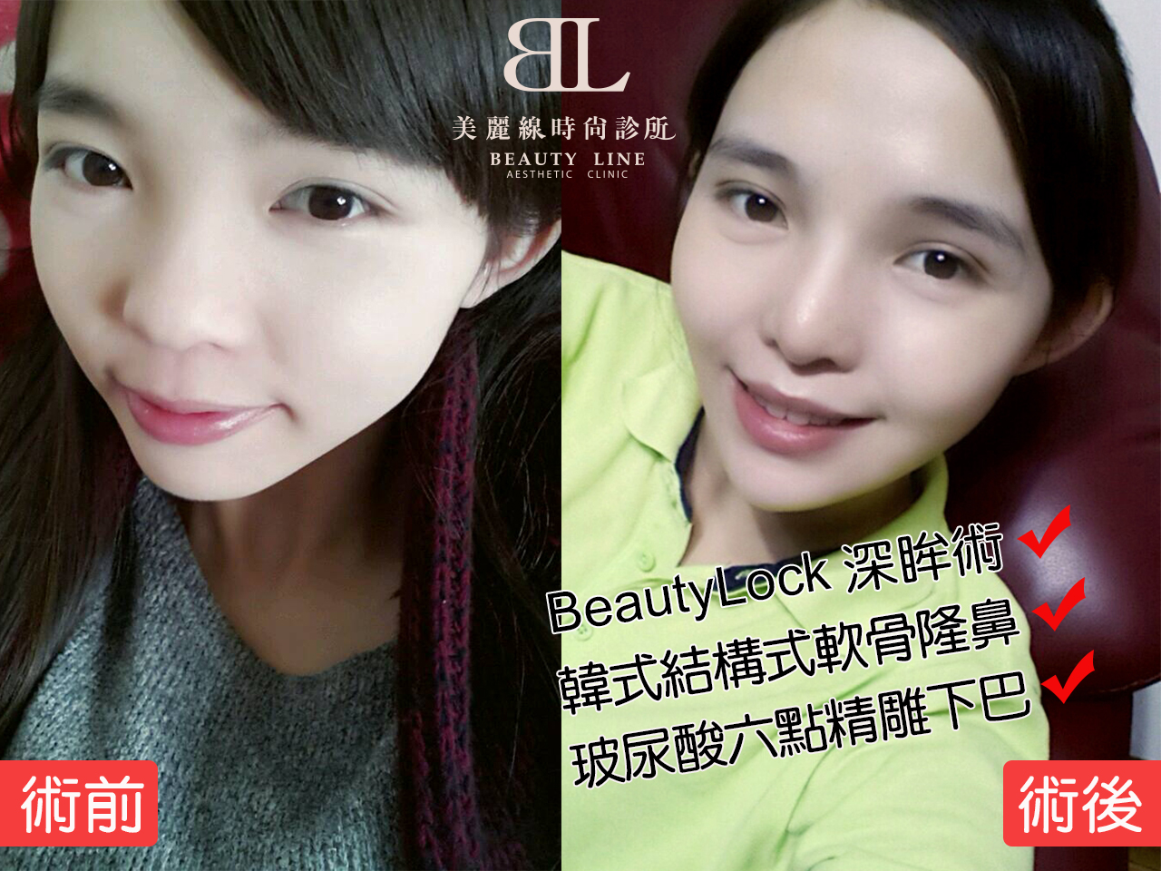 三段結構式肋軟骨隆鼻 X 深眸術 X 微整注射術前術後。