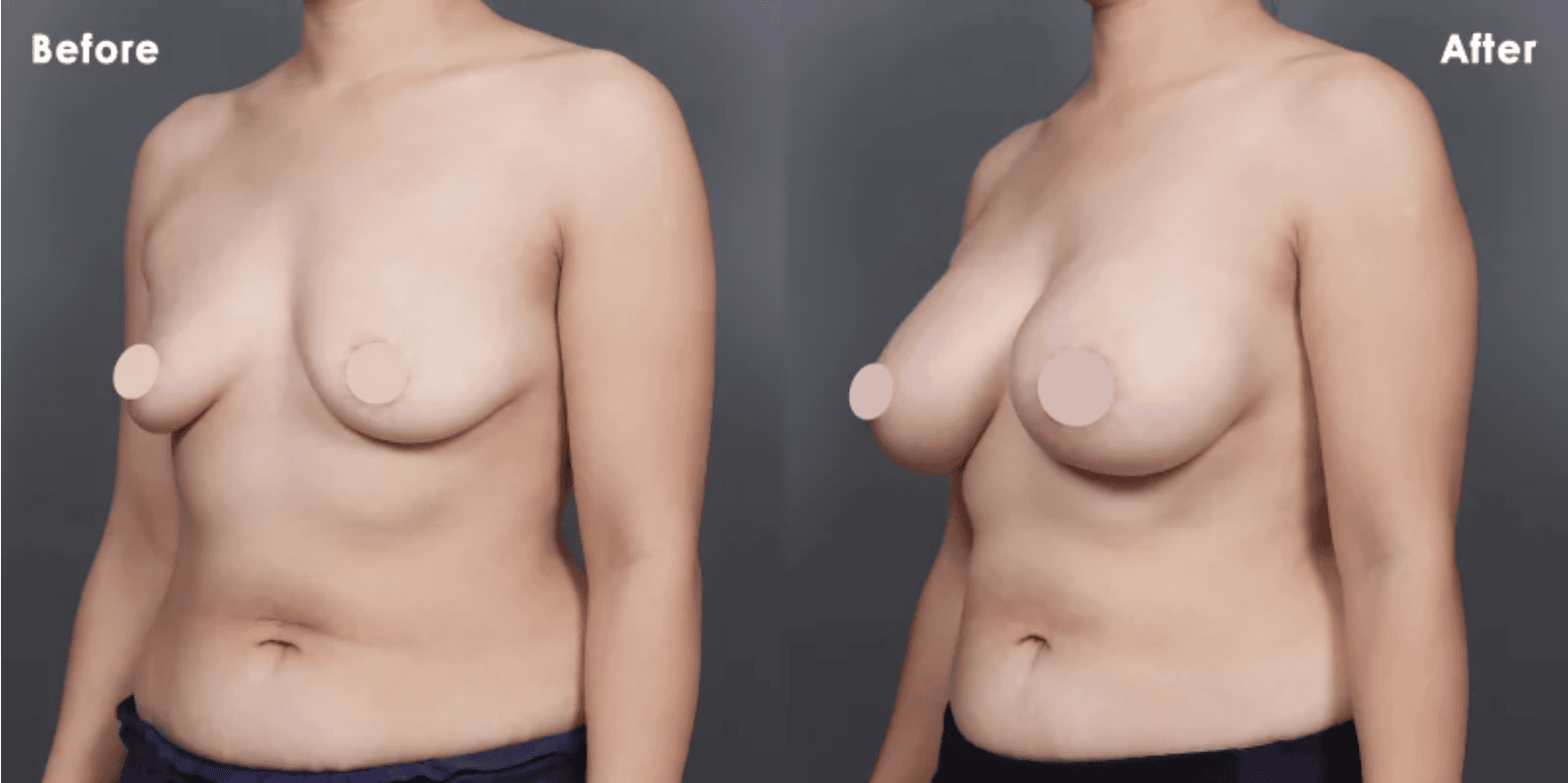 內視鏡魔滴隆乳手術前後女性並排比較，清楚顯示乳房大小和形狀的變化。-B